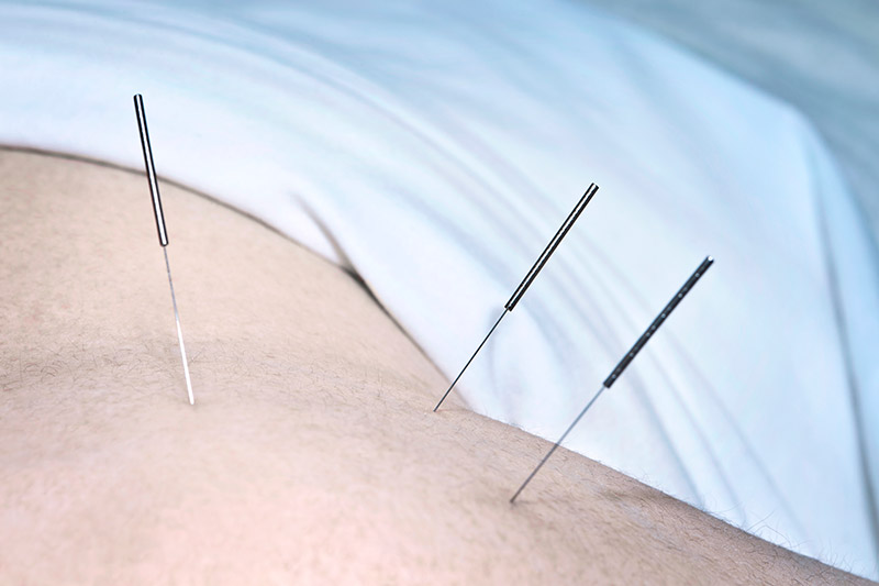A close up of Acupuncture needles